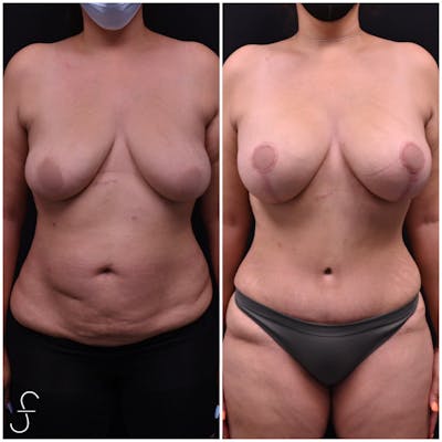 Mommy Makeover Before & After Gallery - Patient 244532 - Image 1