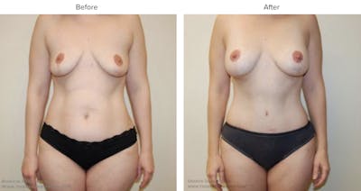 Mommy Makeover Before & After Gallery - Patient 194348 - Image 1