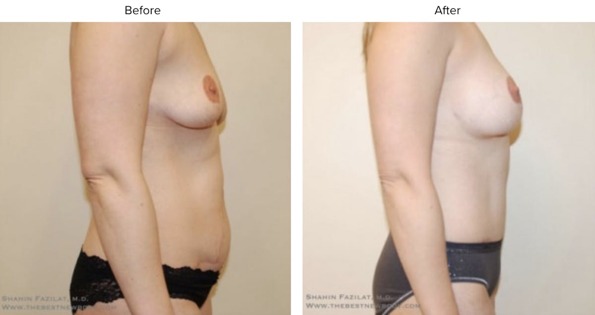 Mommy Makeover Before & After Gallery - Patient 194348 - Image 2