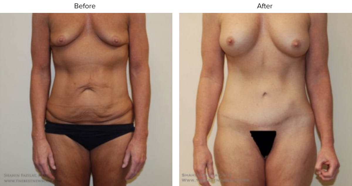 Mommy Makeover Before & After Gallery - Patient 357520 - Image 1