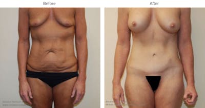 Mommy Makeover Before & After Gallery - Patient 357520 - Image 1