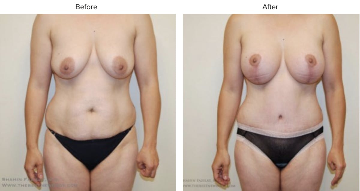 Mommy Makeover Before & After Gallery - Patient 117750 - Image 1