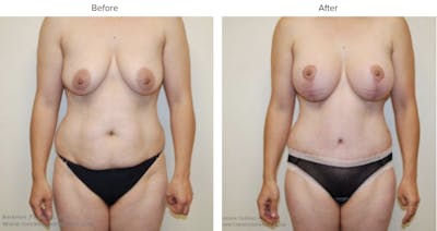 Mommy Makeover Before & After Gallery - Patient 117750 - Image 1