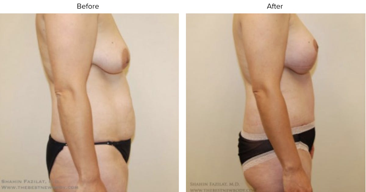 Mommy Makeover Before & After Gallery - Patient 117750 - Image 2