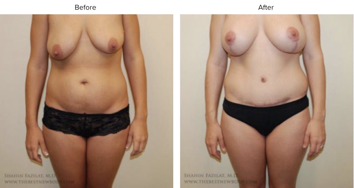 Mommy Makeover Before & After Gallery - Patient 206351 - Image 1