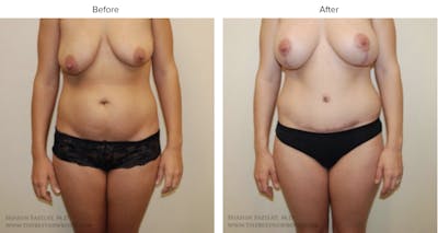 Mommy Makeover Before & After Gallery - Patient 206351 - Image 1