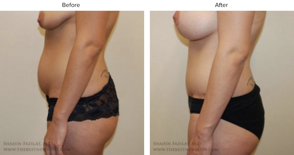 Mommy Makeover Before & After Gallery - Patient 206351 - Image 2