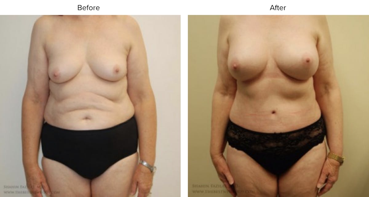 Mommy Makeover Before & After Gallery - Patient 158502 - Image 1