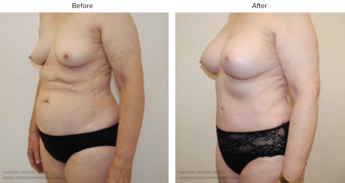 Mommy Makeover Before & After Gallery - Patient 158502 - Image 2