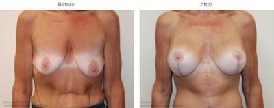 Post Bariatric (After Weight Loss) Before & After Gallery - Patient 285949 - Image 1