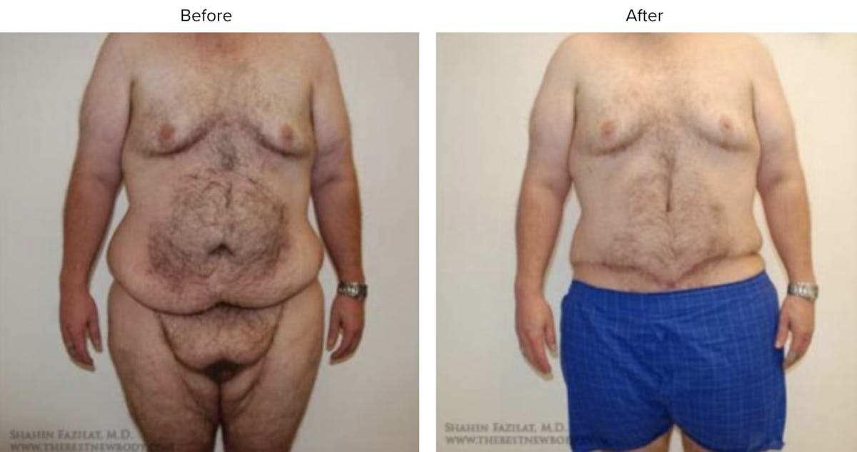 Post Bariatric (After Weight Loss) Before & After Gallery - Patient 770094 - Image 1
