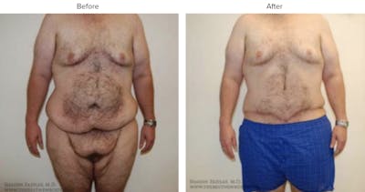 Post Bariatric (After Weight Loss) Before & After Gallery - Patient 770094 - Image 1