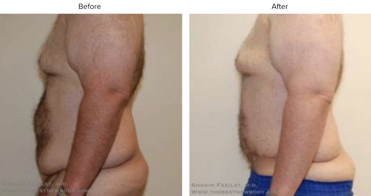 Post Bariatric (After Weight Loss) Before & After Gallery - Patient 770094 - Image 2