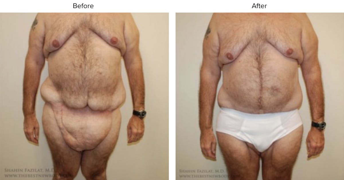 Post Bariatric (After Weight Loss) Before & After Gallery - Patient 296271 - Image 1