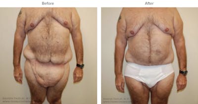 Post Bariatric (After Weight Loss) Before & After Gallery - Patient 296271 - Image 1