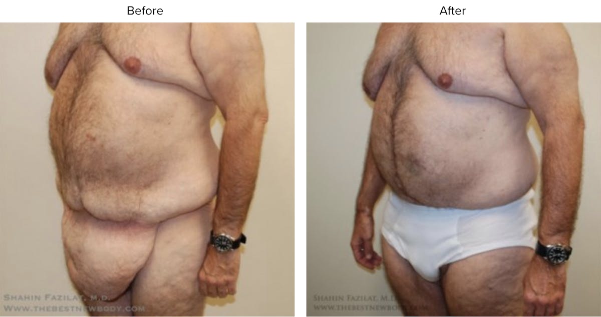 Post Bariatric (After Weight Loss) Before & After Gallery - Patient 296271 - Image 2