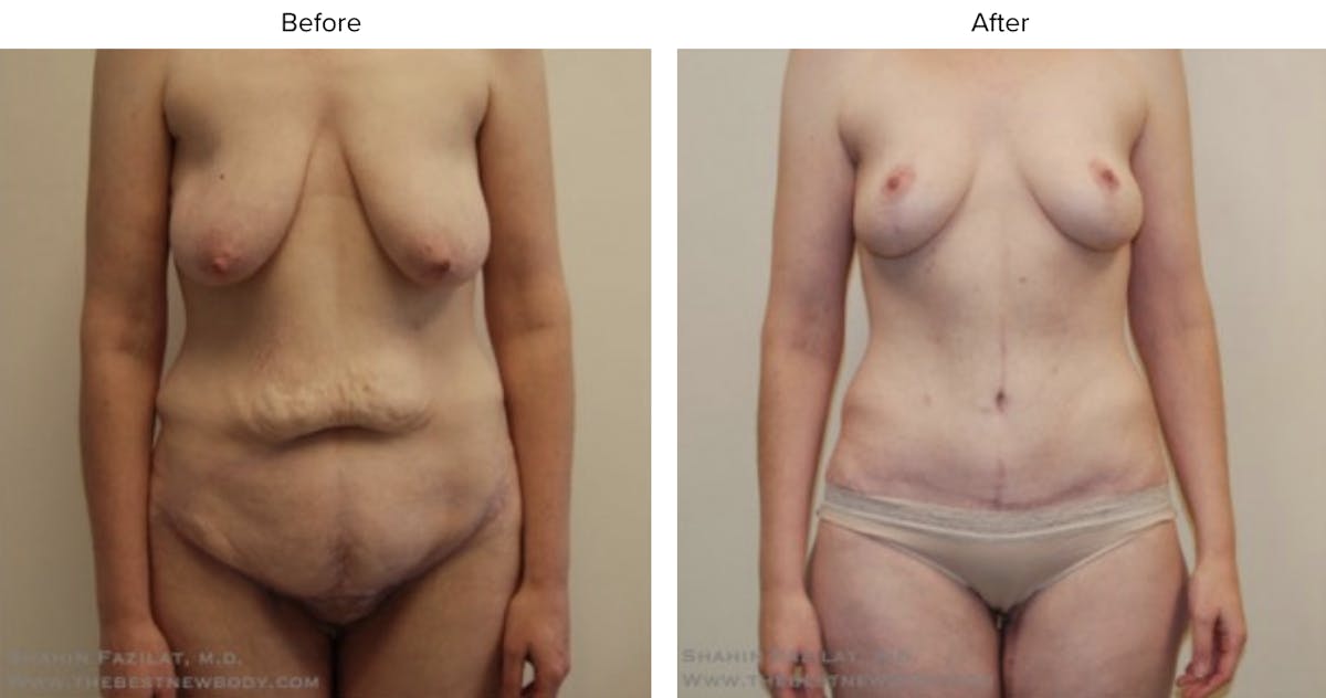Post Bariatric (After Weight Loss) Before & After Gallery - Patient 395687 - Image 1