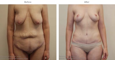 Post Bariatric (After Weight Loss) Before & After Gallery - Patient 395687 - Image 1