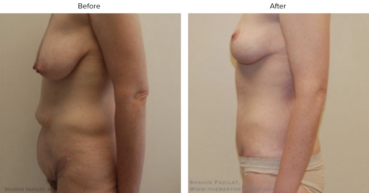 Post Bariatric (After Weight Loss) Before & After Gallery - Patient 395687 - Image 2