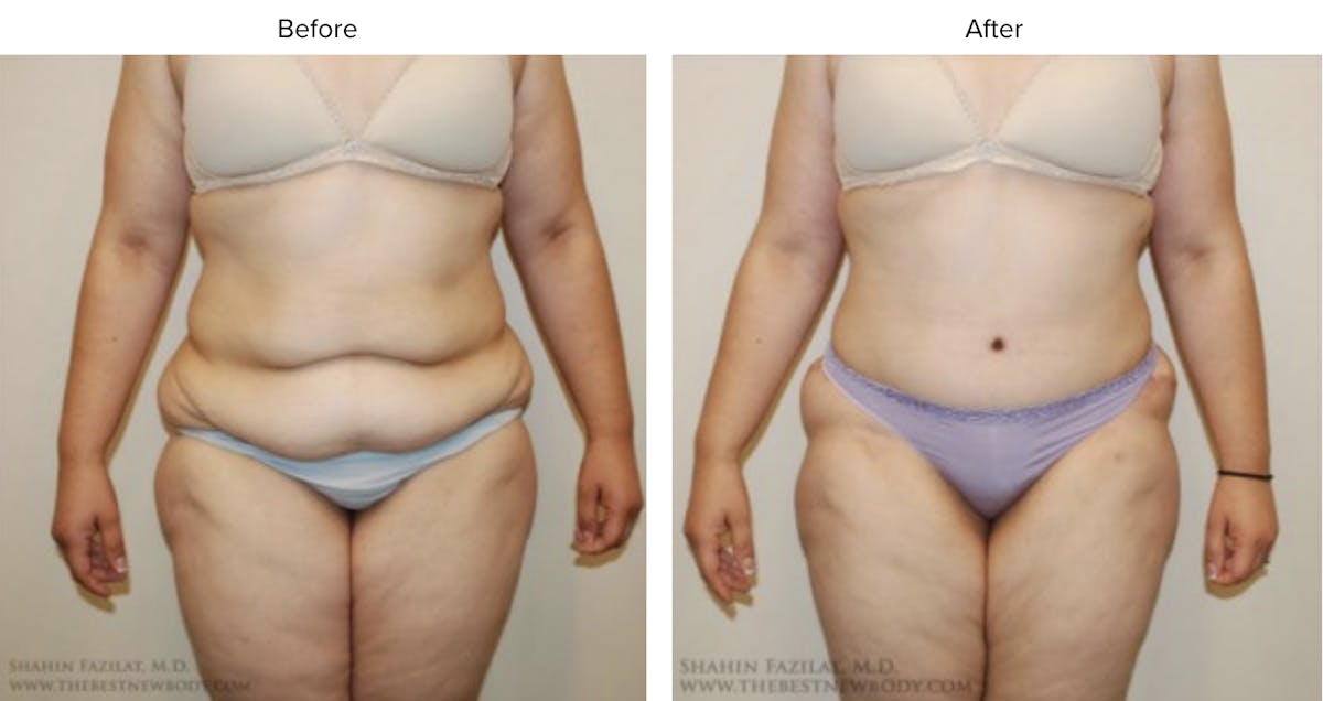 Post Bariatric (After Weight Loss) Before & After Gallery - Patient 101976 - Image 1
