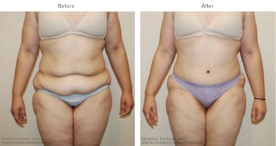 Post Bariatric (After Weight Loss) Before & After Gallery - Patient 101976 - Image 1