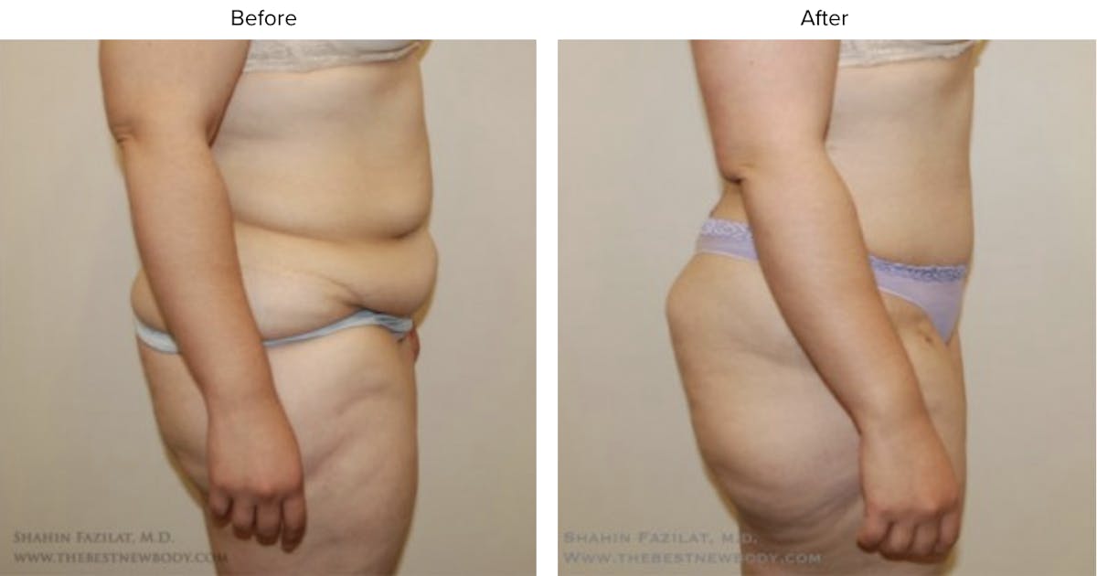 Post Bariatric (After Weight Loss) Before & After Gallery - Patient 101976 - Image 2
