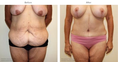 Post Bariatric (After Weight Loss) Before & After Gallery - Patient 136964 - Image 1