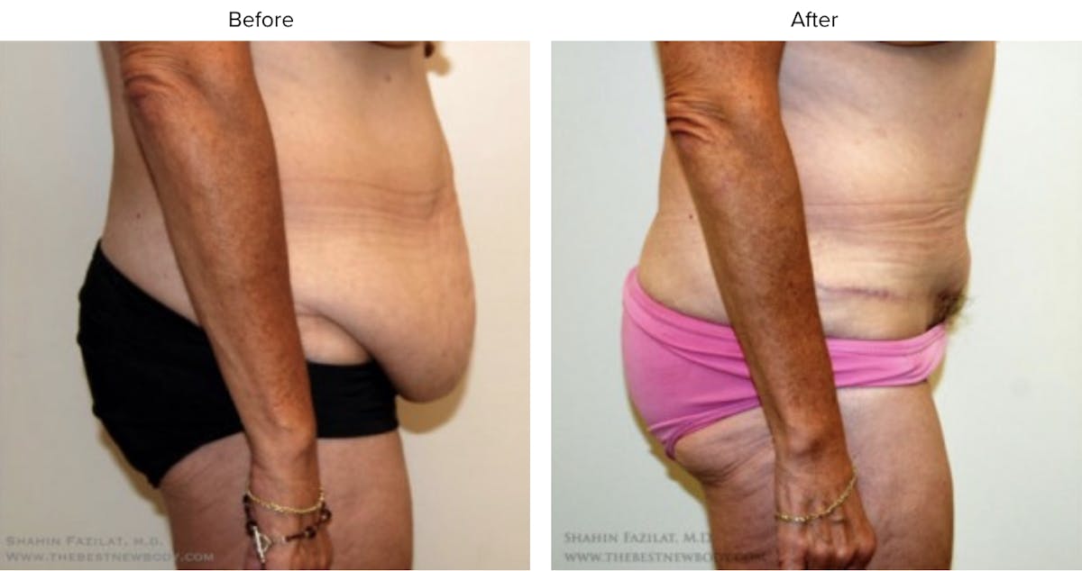 Post Bariatric (After Weight Loss) Before & After Gallery - Patient 136964 - Image 2