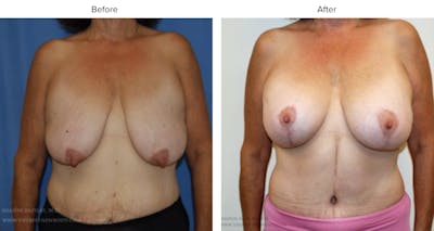 Post Bariatric (After Weight Loss) Before & After Gallery - Patient 339562 - Image 1