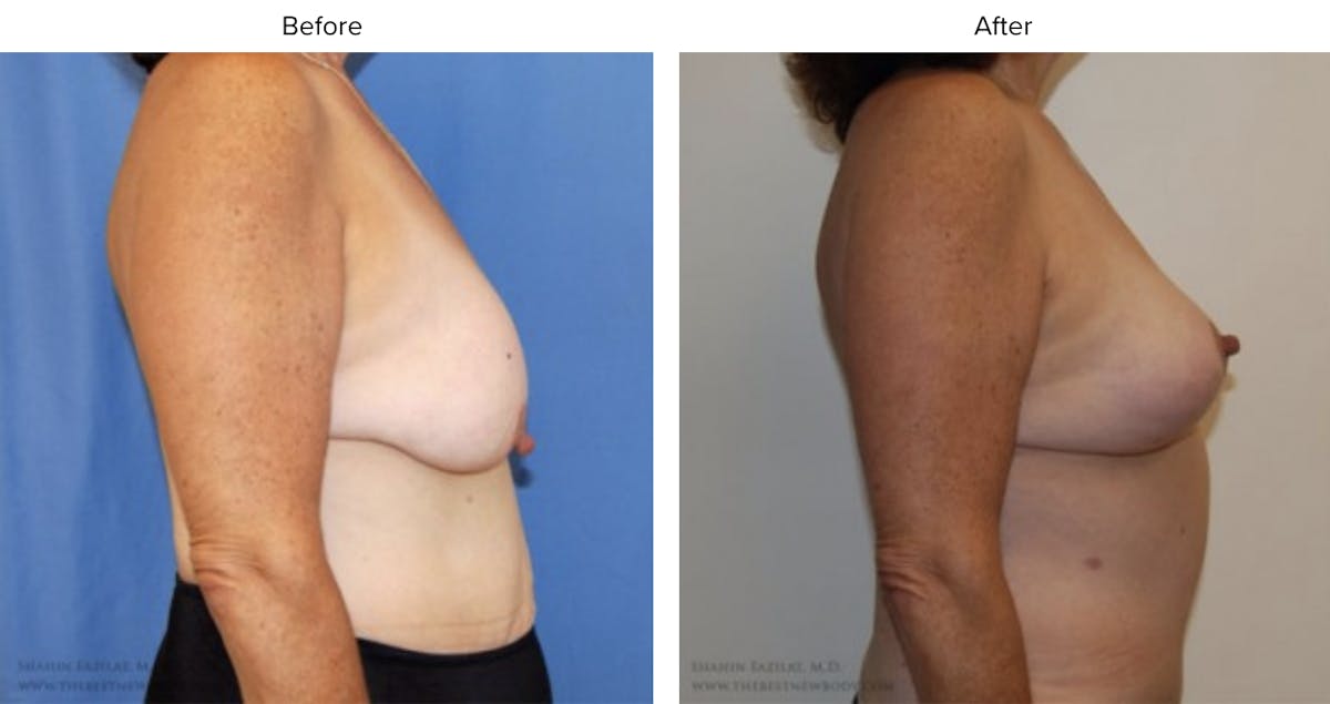 Post Bariatric (After Weight Loss) Before & After Gallery - Patient 327150 - Image 1