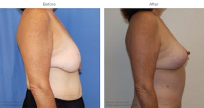 Post Bariatric (After Weight Loss) Before & After Gallery - Patient 327150 - Image 1