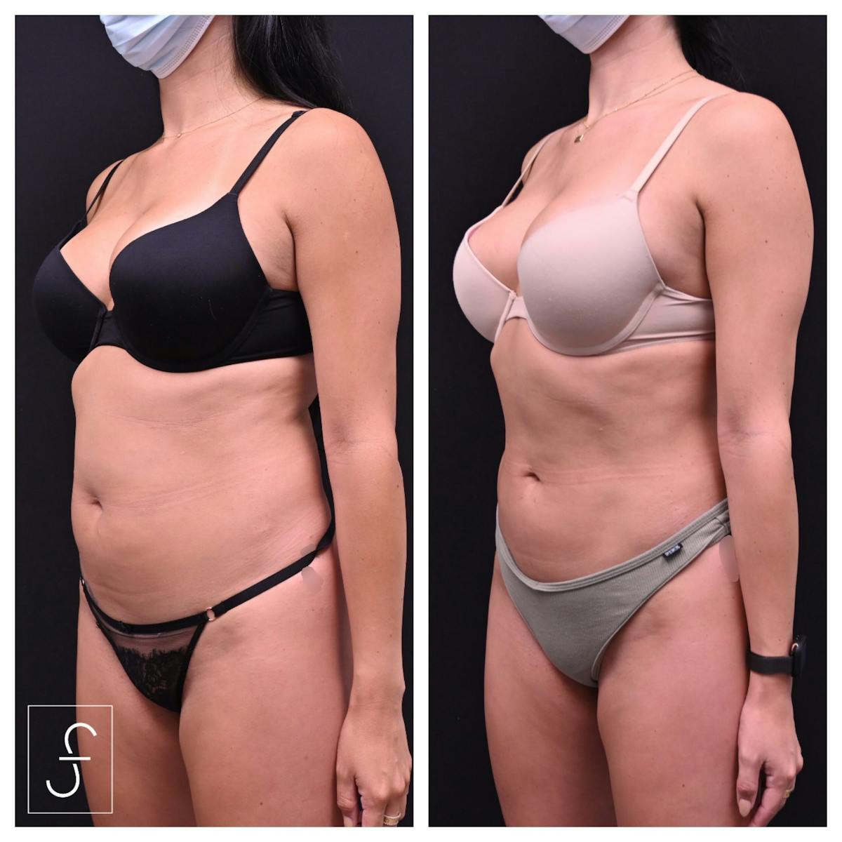 Liposuction Before & After Gallery - Patient 290243 - Image 1