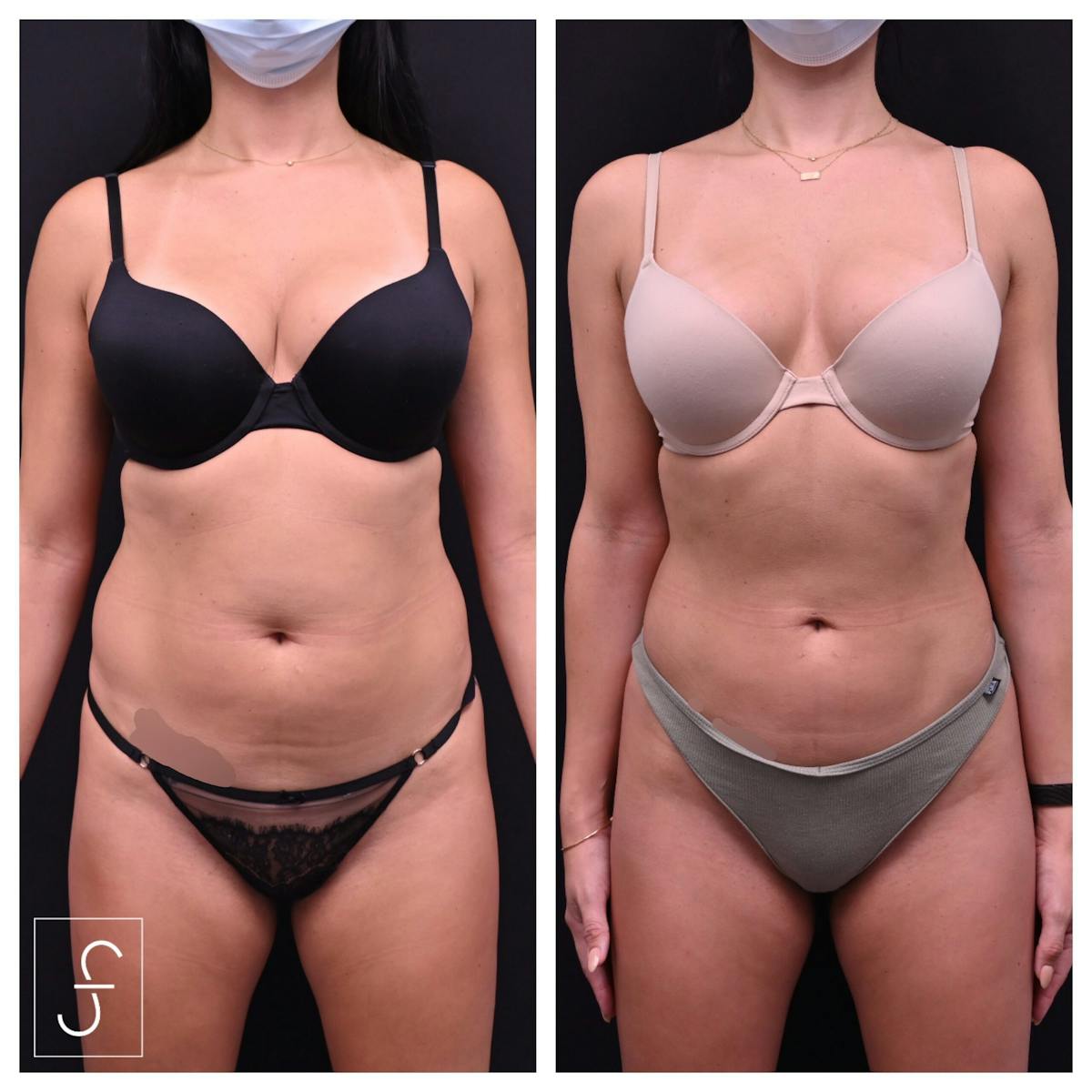 Liposuction Before & After Gallery - Patient 290243 - Image 2