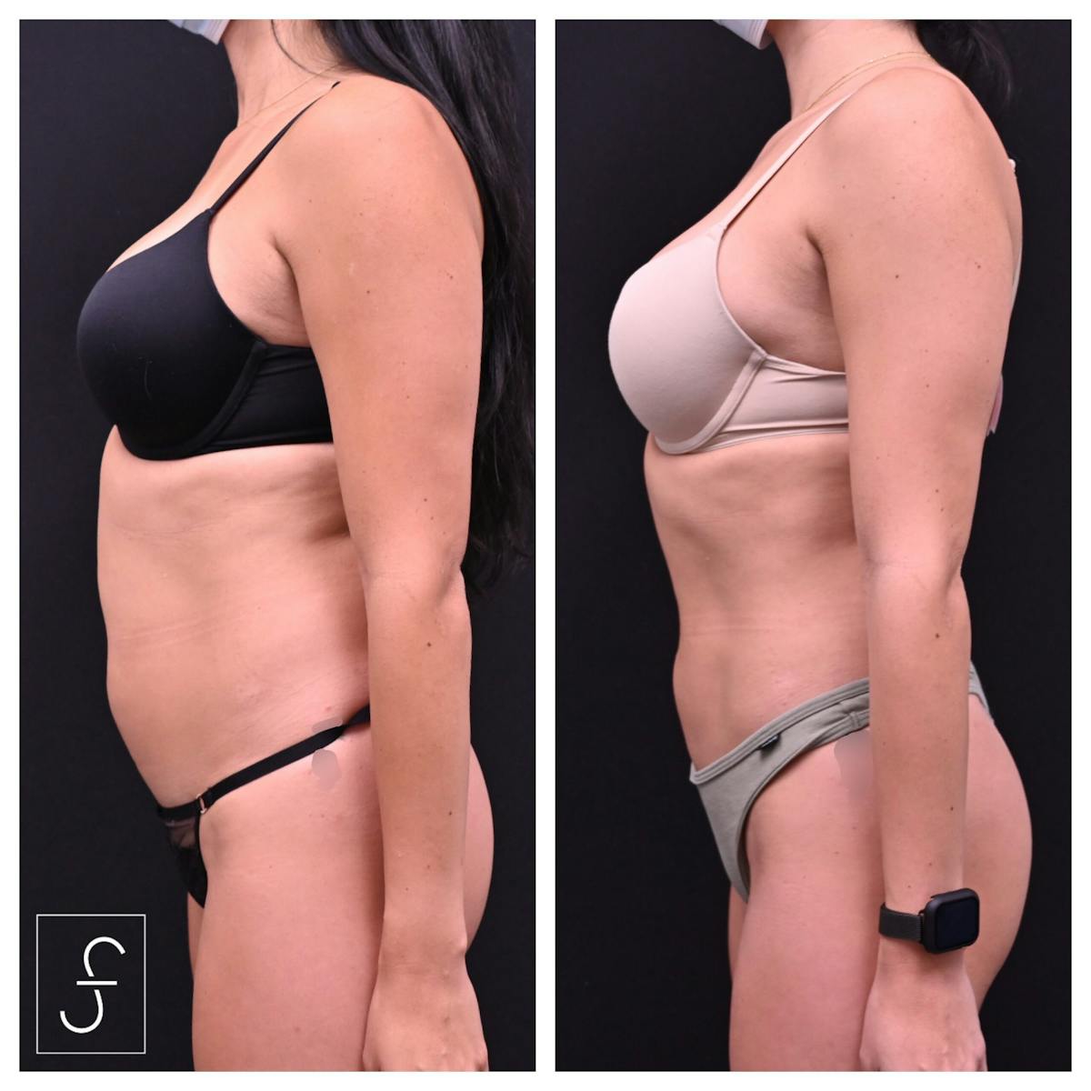 Liposuction Before & After Gallery - Patient 290243 - Image 3