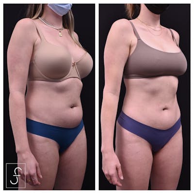 Liposuction Before & After Gallery - Patient 191006 - Image 1