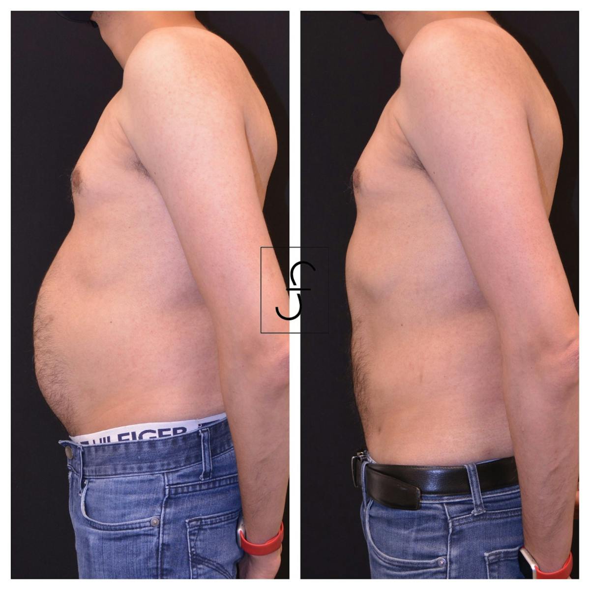 Liposuction Before & After Gallery - Patient 417649 - Image 1