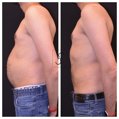 Liposuction Before & After Gallery - Patient 417649 - Image 1