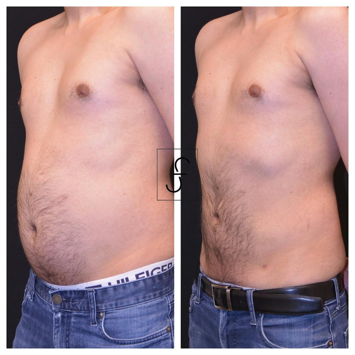Liposuction Before & After Gallery - Patient 417649 - Image 2