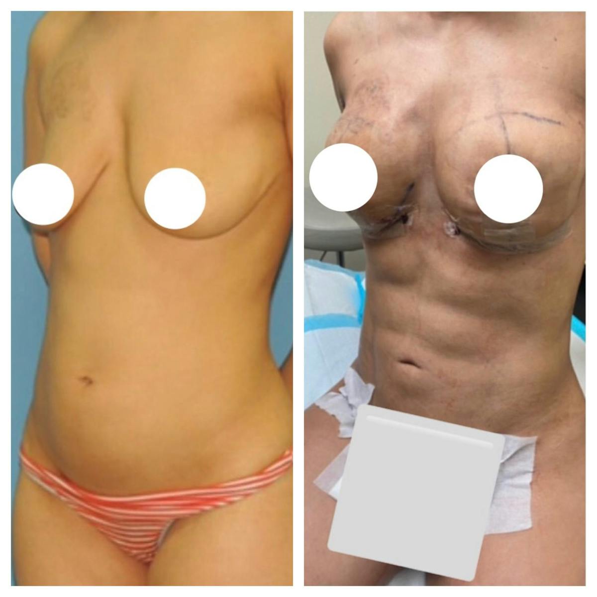 Liposuction Before & After Gallery - Patient 792663 - Image 1