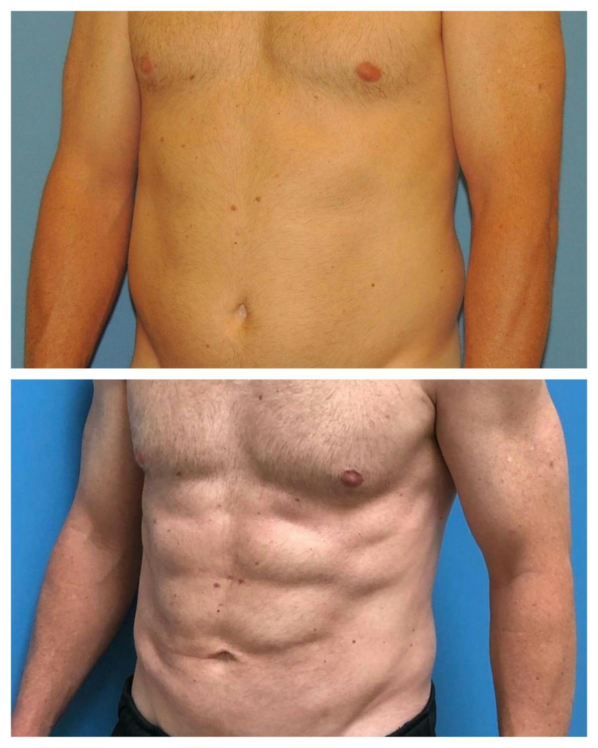 Liposuction Before & After Gallery - Patient 395695 - Image 1