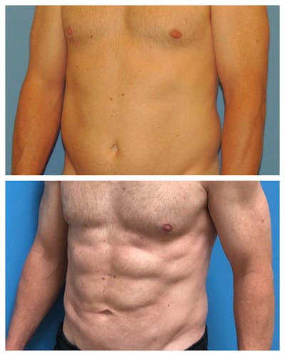 Liposuction Before & After Gallery - Patient 395695 - Image 1