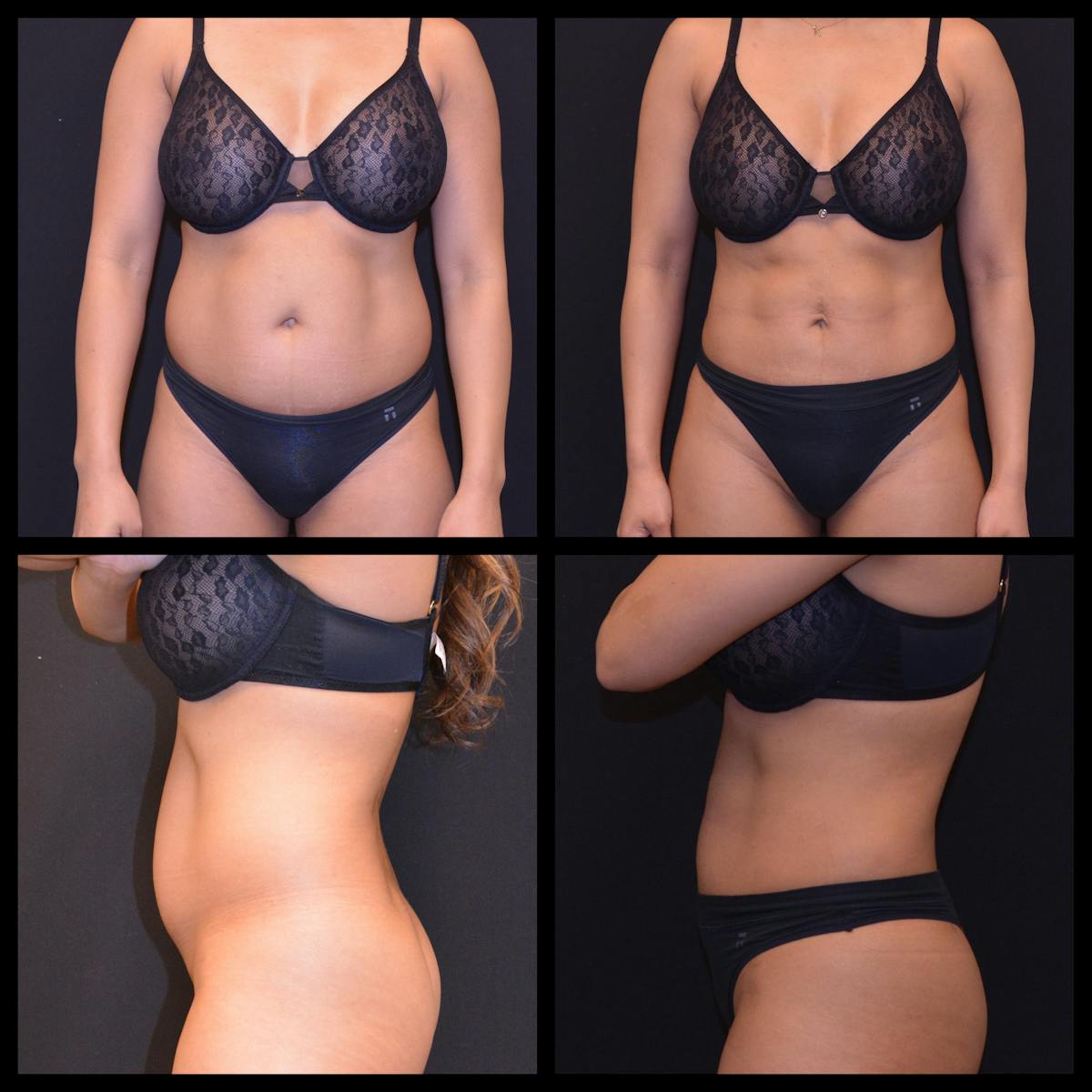 Liposuction Before & After Gallery - Patient 823893 - Image 1