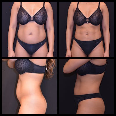Liposuction Before & After Gallery - Patient 823893 - Image 1