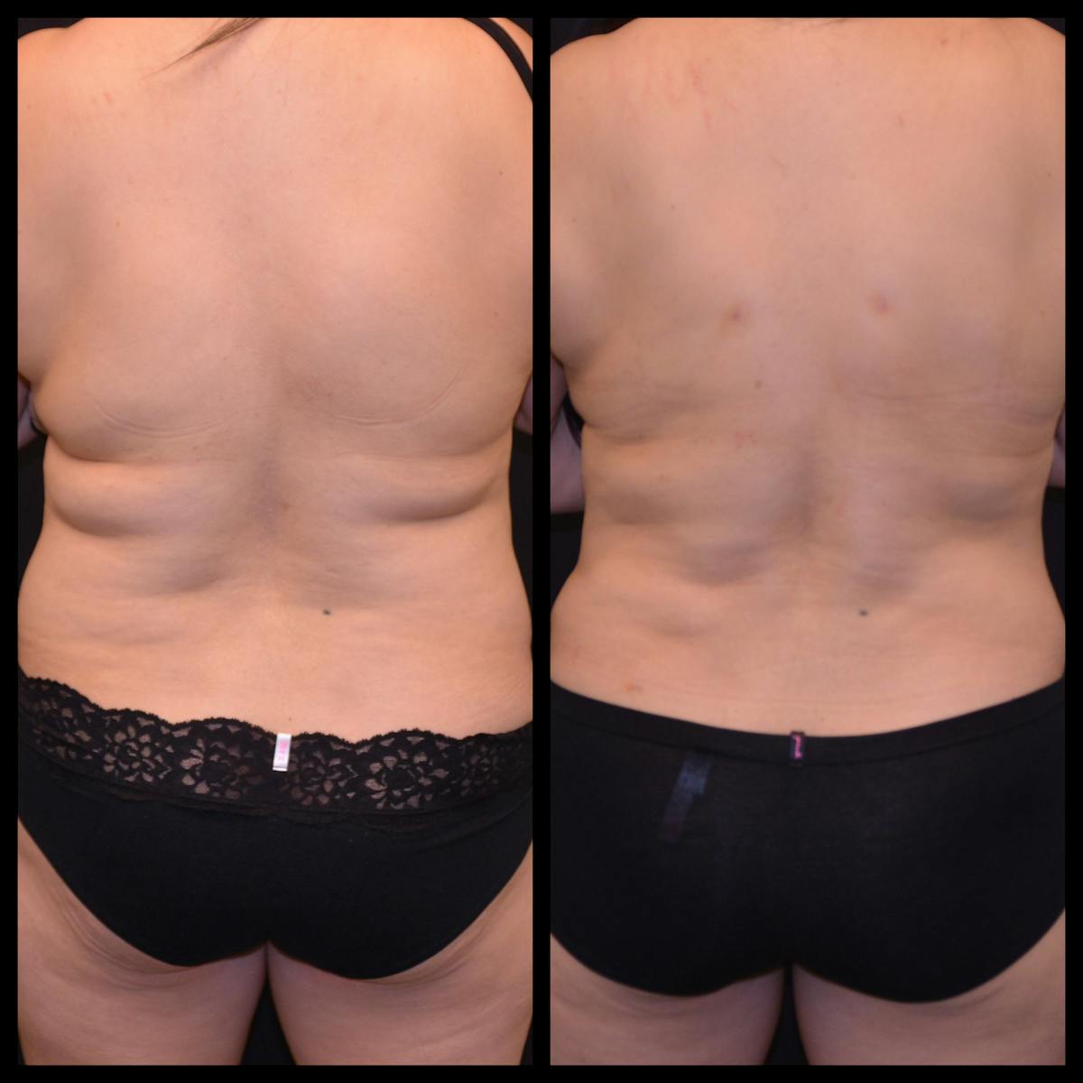 Liposuction Before & After Gallery - Patient 423240 - Image 1