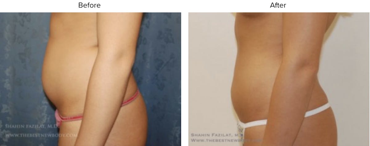 Liposuction Before & After Gallery - Patient 273842 - Image 1
