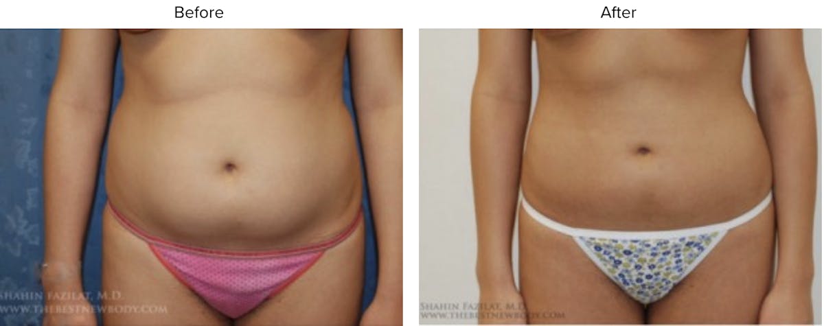 Liposuction Before & After Gallery - Patient 273842 - Image 2