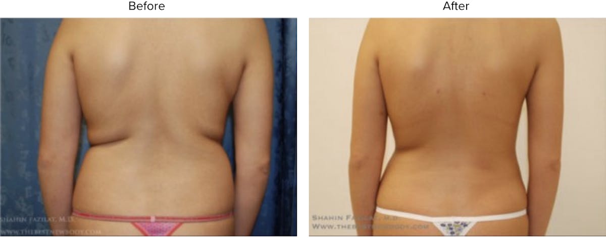 Liposuction Before & After Gallery - Patient 273842 - Image 3