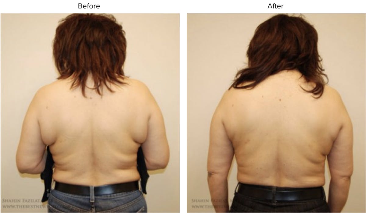 Liposuction Before & After Gallery - Patient 423605 - Image 1