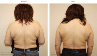 Liposuction Before & After Gallery - Patient 423605 - Image 1