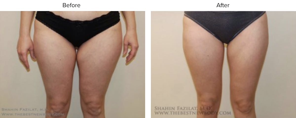 Liposuction Before & After Gallery - Patient 284255 - Image 1